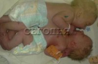 В Донецкой области родились сиамские близнецы