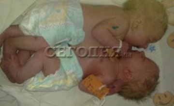 Сиамские близнецы из Донецкой области умерли