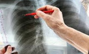 В Днепропетровской области на 12,5 % снизился уровень заболеваемости населения туберкулезом, - СЭС