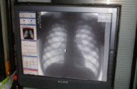 Ежегодно в Днепропетровской области выявляют порядка 3 тыс новых больных туберкулезом, - эксперт