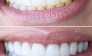 Лазерное отбеливание зубов в клинике Medical Dental Group (ВИДЕО)