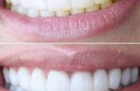 Лазерное отбеливание зубов в клинике Medical Dental Group (ВИДЕО)
