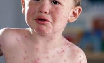 Около 5% детского населения Днепропетровщины страдают аллергией, - медики