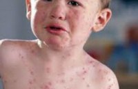 Около 5% детского населения Днепропетровщины страдают аллергией, - медики