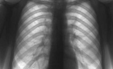 Уровень заболеваемости туберкулезом взрослых в Днепропетровской области снижается