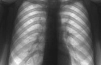 Уровень заболеваемости туберкулезом взрослых в Днепропетровской области снижается