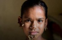 В Бангладеше 10-летняя девочка заболела синдромом «человека-дерева»