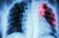 Состояние заболеваемости туберкулезом в Днепре 